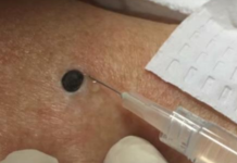 ŽENA JE GAJILA OVO NA LEĐIMA: Kada je doktorka uzela špric i bocnula, shvatit ćete zašto je SNIMAK pregledalo 33 miliona ljudi!