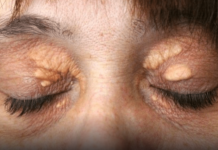 Ako vam se u blizini očiju pojavilo masno tkivo: Nipošto nemojte ga stiskati, morate učiniti sledeće da nestane! (Foto)