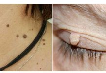 SKINITE BRADAVICE SA KOŽE JEDNOM NAMIRNICOM: Ništa lakše!