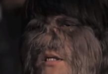 DEVOJKA SA LICEM MAJMUNA SE UDALA PA OBRIJALA LICE: Kada su je videli, ljudi se šokirali! Pogledajte kako SADA IZGLEDA