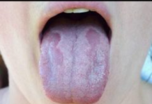 KANDIDA UNIŠTAVA ORGANIZAM I IMUNITET: Napravite ovaj napitak I ZAUVIJEK JE SE RIJEŠITE (RECEPT)