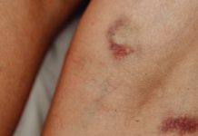 Imate li modrice po cijelom tijelu? možete patiti od ovoga