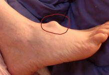 KVRŽICE NA NOZI MOGU DA UKAŽU NA PO ŽIVOT OPASNO STANJE: Ne ignorišite ove simptome