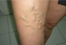 UKLONITE CELULIT I PROŠIRENE VENE, KOŽA ĆE BITI ZATEGNUTA KROZ NEKOLIKO DANA: Ovo Ulje Je Pravo Čudo (RECEPT)