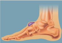 KVRŽICE NA NOZI MOGU DA UKAŽU NA PO ŽIVOT OPASNO STANJE: Ne ignorišite ove simptome