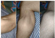 AKO PRIMIJETITE OVE PROMJENE NA TIJELU, PROVJERITE ŠEĆER U KRVI: Rani simptomi dijabetesa