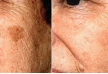 SODA BIKARBONA uklanja STARAČKE MRLJE! Ovo morate napraviti…