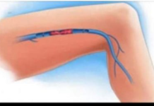 KAKO PREPOZNATI SIMPTOME TROMBA? Ovo su znakovi na koje trebate obratiti pažnju