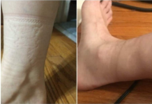 TRAGOVI OD ČARAPA NA VAŠIM NOGAMA: Evo šta to otkriva o vašem zdravlju, važan pokazatelj