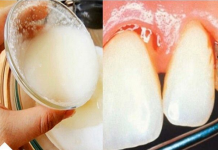 SKINITE KAMENAC I UNIŠTITE BAKTERIJE U USTIMA SA SAMO JEDNIM SASTOJKOM (RECEPT)