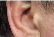 KAKO SIGURNO UKLONITI UŠNI VOSAK: METODE PREPORUČENE OD PEDIJATRA DR. GILA