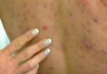 IMATE LI AKNE NA LEĐIMA? EVO KAKO DA IH SE REŠITE: Trikovi Koji Će Vam Pomoći