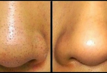 Trik koji garantovano radi: Riješite se mitesera s cijelog lica za deset minuta