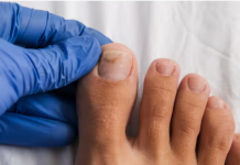 Jedan jeftini sastojak zauvek rešava gljivice na noktima, nije soda bikarbona i sirće