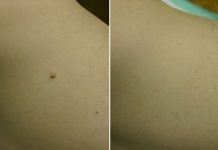 SITNE BRADAVICE SA KOŽE NESTAJU, RECEPT KOJI SVI TREBAJU ZAPISATI: Potrebni Su Vam Ovi Sastojci- BRZO I BEZBJEDNO