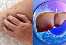 PRIPAZITE NA OVE SIMPTOME: ZNAKOVI KOJI UKAZUJU NA OŠTEĆENJE JETRE