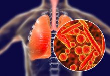 Učestalost hodajuće upale pluća je u porastu. Ako osjetite bilo koji od ovih simptoma, obratite se svom liječniku.