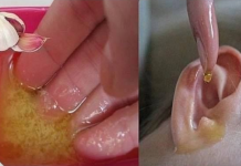 Liječenje upala uha maslinovim uljem.