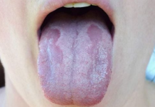 Kandida uništava organizam