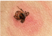 KAKO UKLONITI KRPELJA POMOĆU OBIČNE SOLI: Poslije ovog, krpelj odmah sam izađe na površinu kože!