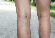 ČUDOTVORNI MELEM: Pomiješajte ova tri sastojka i proširene vene će nestati preko noći