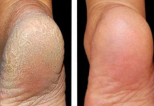 Zaboravite na ispucale pete, kurje oko i gljivice na nogama: Jeftina namirnica je pravi spas