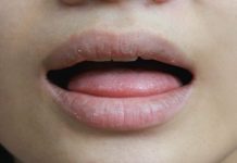NE ZANEMARUJTE OVAJ SIMPTOM! Evo šta znače suha usta!