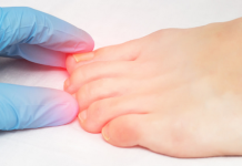 IMATE URASLI NOKAT?! – Ovako za samo 2 minute riješite nelagodu i bol!