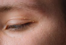 Uklanjaju se jednstavno, TREBAJU VAM 3 SASTOJKA KOJA IMATE U KUĆI – NI SLUČAJNO IH NE ISTISKUJTE,AKO IMATE OVE BIJELE TAČKICE NA LICU!