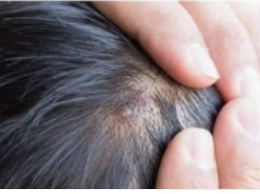 BUBULJICE NA GLAVI SU SVE ČEŠĆI PROBLEM: Ni slučajno ih ne istiskujte, evo zašto se javljaju I ŠTA TREBATE URADITI DA NESTANU