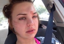 ISCIJEDILA JE BUBULJICU IZNAD OBRVE: Poslije sat vremena lice joj se POTPUNO izobličilo, i sve zbog OVE STVARI koju koristi svaka žena (FOTO)