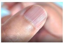 Doktorica otkrila i možda ćete se iznenaditi: IMATE LI OVAKVE IZBOČINE NA NOKTIMA – evo šta one znače!