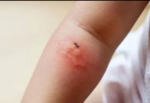 OPASAN INSEKT HARA SRBIJOM: Poznati novinar proživio KATASTROFU nakon ujeda BUBE