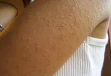 EVO ZAŠTO IMATE “PUREĆU KOŽU”: Žene često imaju ovaj problem!