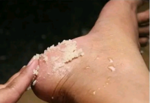 GENIJALAN RECEPT ZA GRUBE RUKE, ISPUCALE PETE, KURJE OČI I KRIVE NOKTE NA NOGAMA