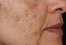 Evo kako da sa ovim jednostavnim trikom od 2 sastojka izbrišete mrlje s kože!