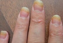 MUČE VAS umor, tanka kosa ili lomljivi nokti? Evo što vam NEDOSTAJE U ISHRANI