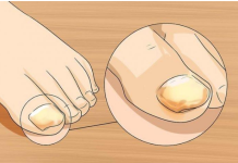 Sinoć sam ovom mješavinom uspješno izliječila gljivice na noktima i na moje iznenađenje nestale su kao nekom čarolijom.