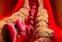 Pet prirodnih i efikasnih metoda koje pomažu u čišćenju arterija: Ako primetite ove znake to znači da su pune plaka