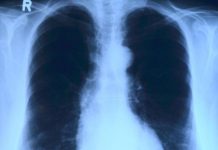 Opaka bolest u porastu, izdali upozorenje građanima: Ovo su simptomi