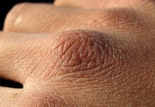 Puca vam koža, opada kosa ili imate grčeve? Tijelo vam govori da vam nedostaju ovi vitamini