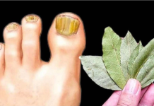 Ova domaća KUPKA trenutno ubija gljivice na noktima: Pomoći će čak i u najgorim slučajevima!