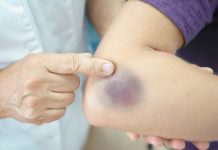 MODRICE JAVLJAJU PO TIJELU: NEMA VEZE SA POVREDAMA, PRAVI RAZLOG ĆE VAS ŠOKIRATI