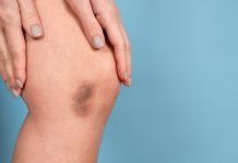 Ovi simptomi ukazuju da vam nedostaje vitamin C: Ne ignorišite ih