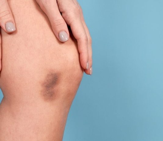 Ovi simptomi ukazuju da vam nedostaje vitamin C: Ne ignorišite ih