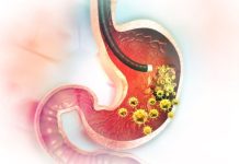 5 ranih simptoma raka želuca: Tumor može da raste godinama, a svi pacijenti prvo osjete ovo