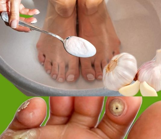 Kurje oko nestaje bez traga: bijeli luk i ova smjesa čine čudo!