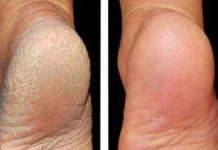 ZA MEKA STOPALA POTREBNA SU VAM SAMO 3 SASTOJKA IZ KUHINJE: Potopite noge u ovu smjesu na 15 minuta i recite zbogom ispucalim petama