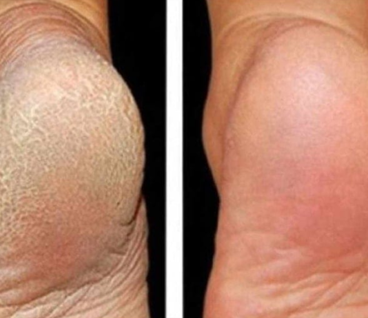 ZA MEKA STOPALA POTREBNA SU VAM SAMO 3 SASTOJKA IZ KUHINJE: Potopite noge u ovu smjesu na 15 minuta i recite zbogom ispucalim petama