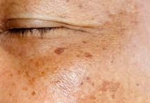 UZ P0M0Ć PERŠINA ZAUVlJEK UKL0NlTE STARAČKE MRLJE! Ovo Morate Napraviti…